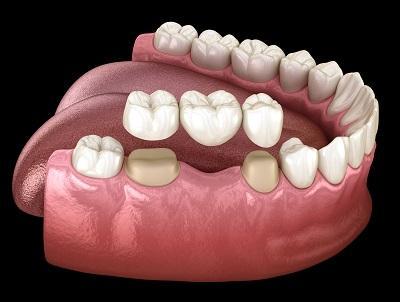 photo of three teeth forming a bridge at Smile Ninja Dental in Fort Worth,Texas and all of their low-cost dental crown options for family dentistry.